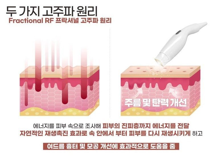 폴카 RF 피부관리 기기 프락셀 고주파 프락셔널 피부 관리기 프락셀 피부재생 콜라겐생성 리프팅 노화 눈가주름 - 한국
