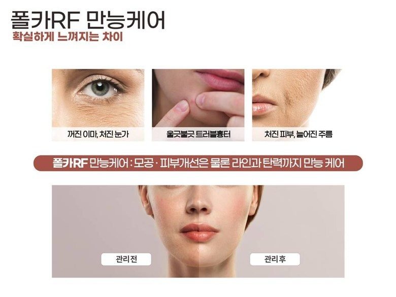 폴카 RF 피부관리 기기 프락셀 고주파 프락셔널 피부 관리기 프락셀 피부재생 콜라겐생성 리프팅 노화 눈가주름 - 한국